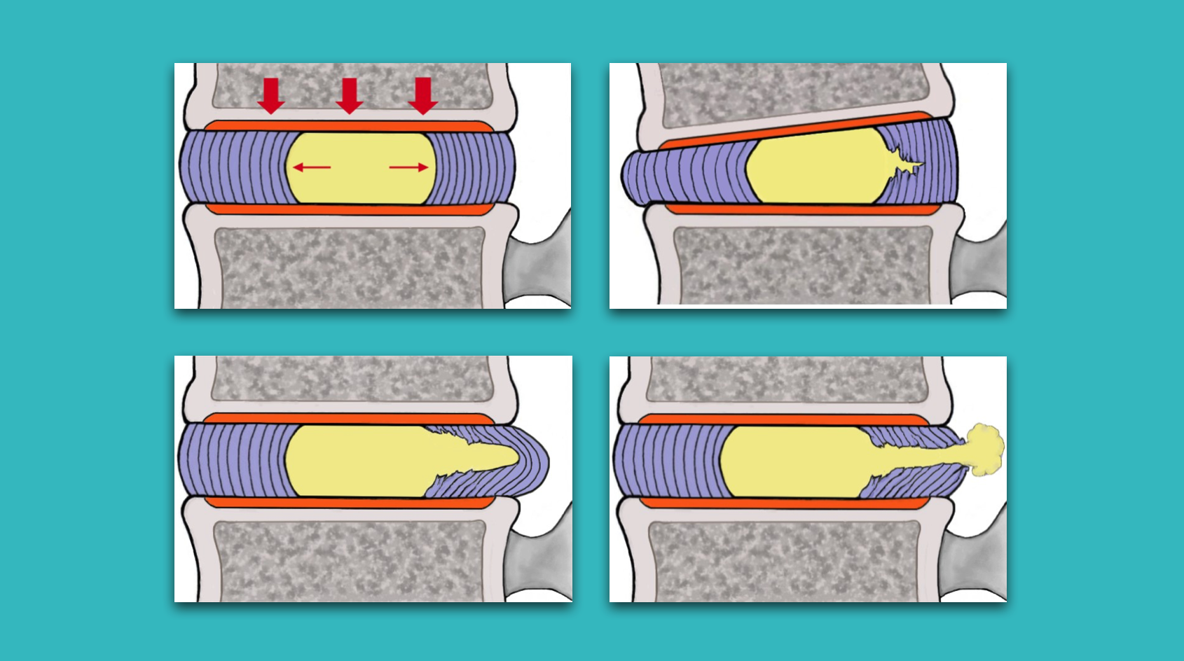 Sciatica: Confident Diagnosis and Management
