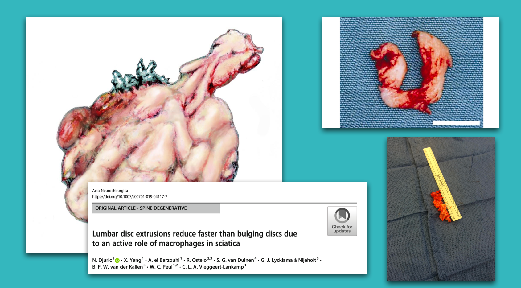Lecture: Assessment of Sciatica