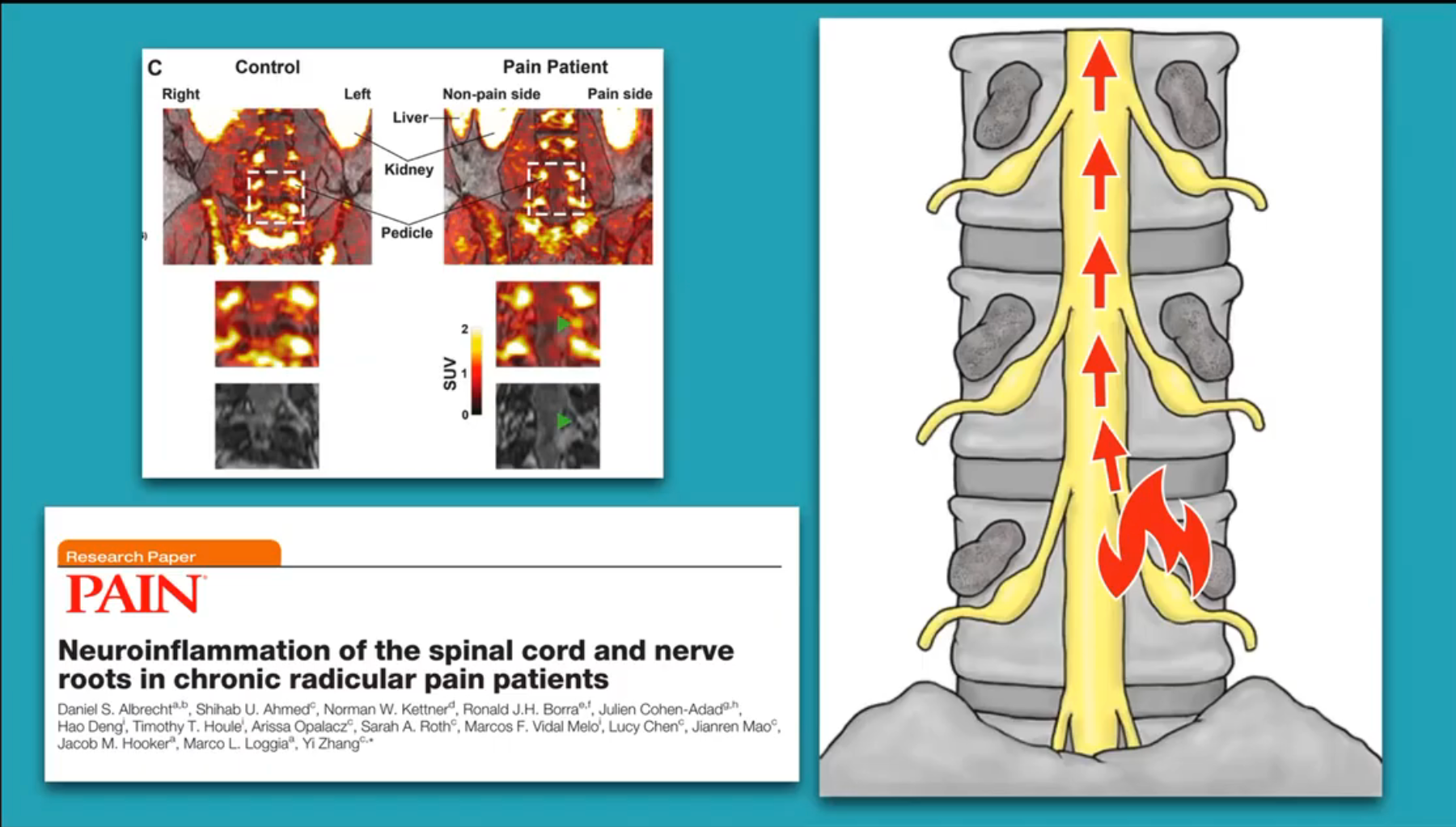 [Lecture Recording] Sciatica: Confident Diagnosis and Management