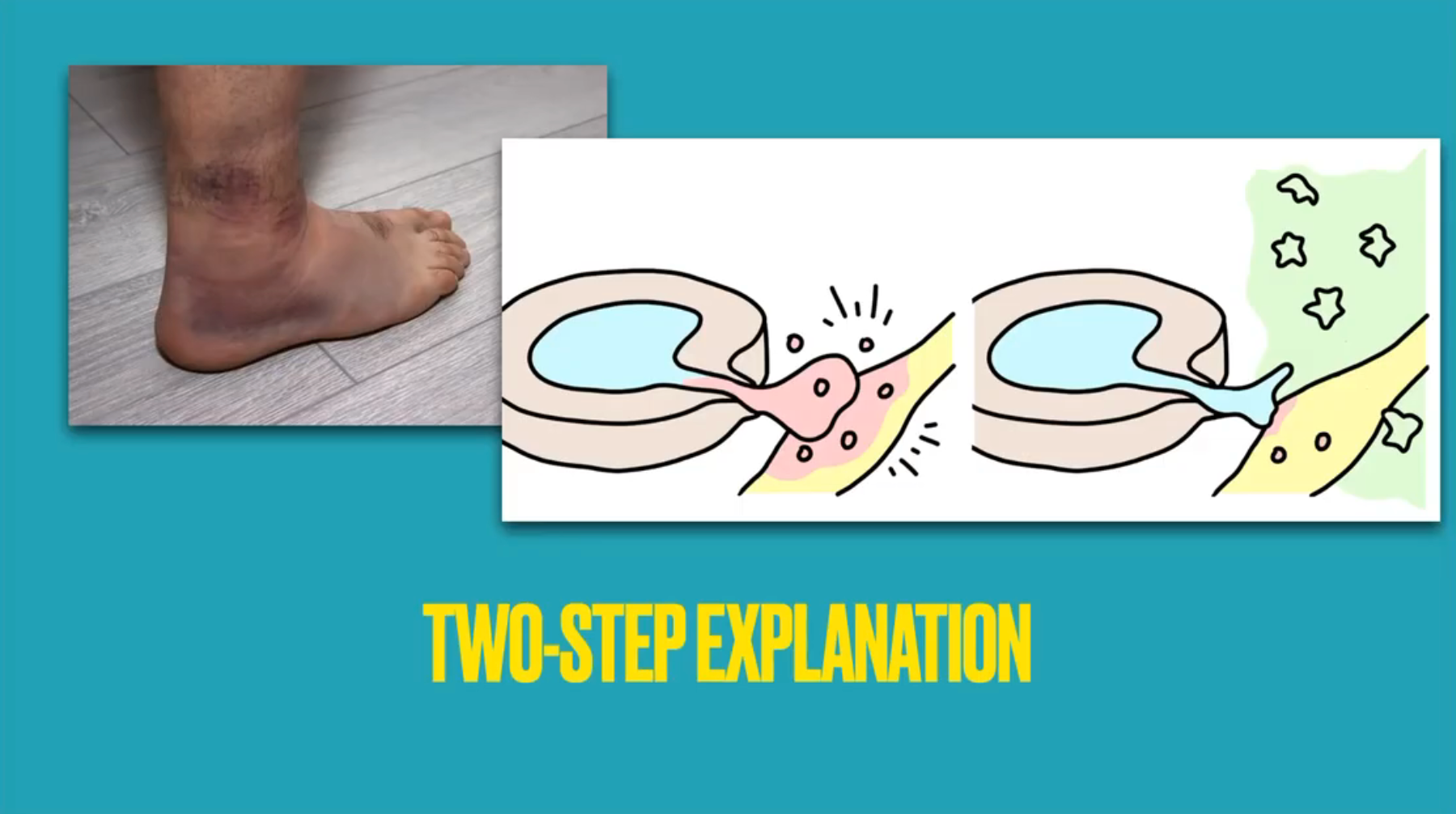 [Lecture Recording] Sciatica: Confident Diagnosis and Management